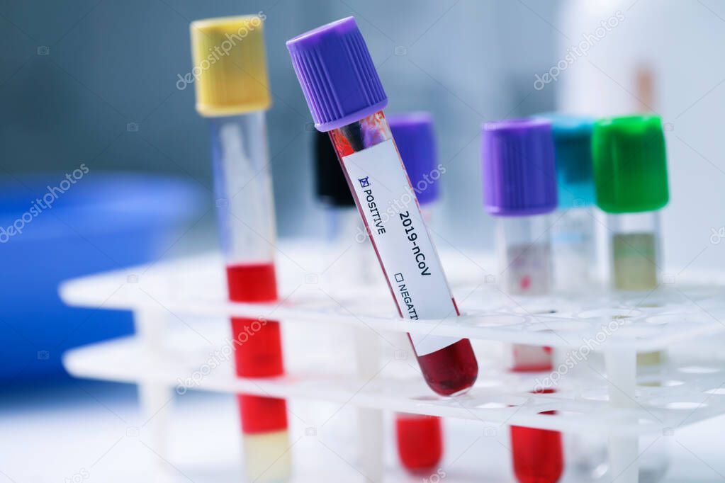 blood sample tube with positive coronavirus test in laboratory