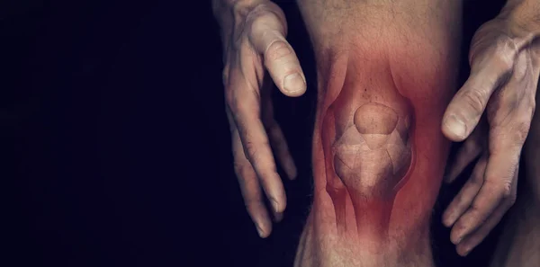 Боль Колене Мужская Нога Изображением Воспаления Костного Сустава Черном Фоне — стоковое фото