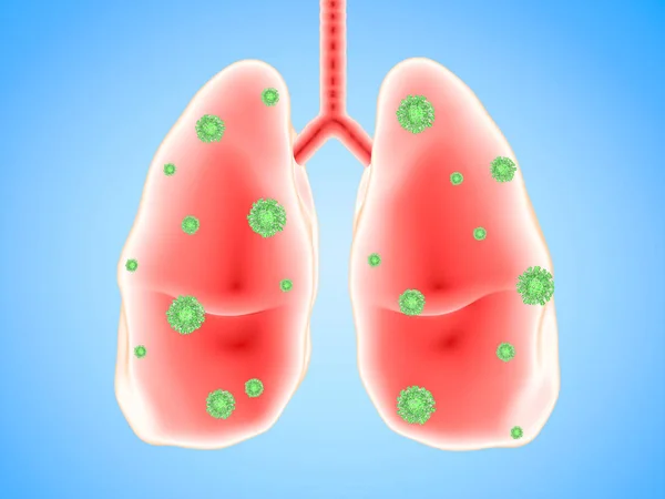 Enfermedad pulmonar con células bacterianas —  Fotos de Stock