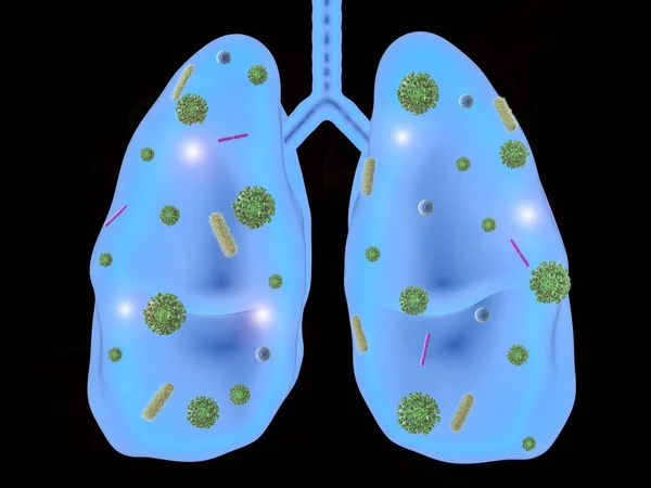 肺部疾病与细菌细胞 — 图库照片