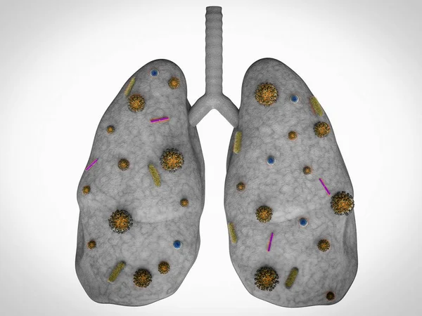 肺部疾病与细菌细胞 — 图库照片