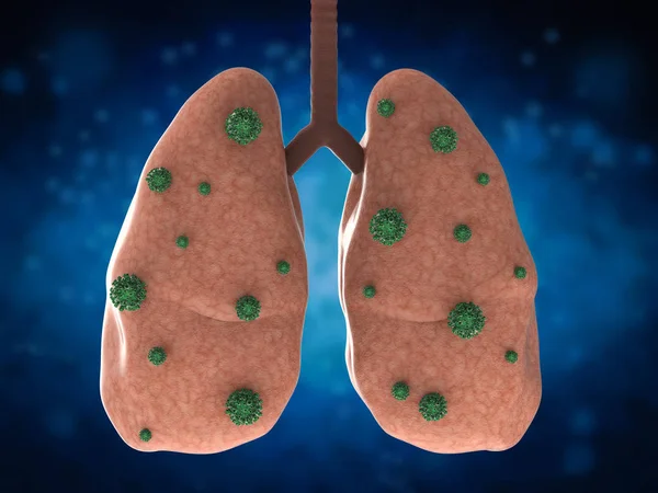 Lungenkrankheit mit Bakterienzellen — Stockfoto