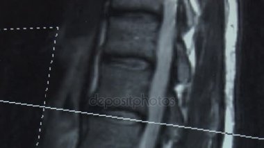 Tomografi, omurga görüntüleme. Resim.