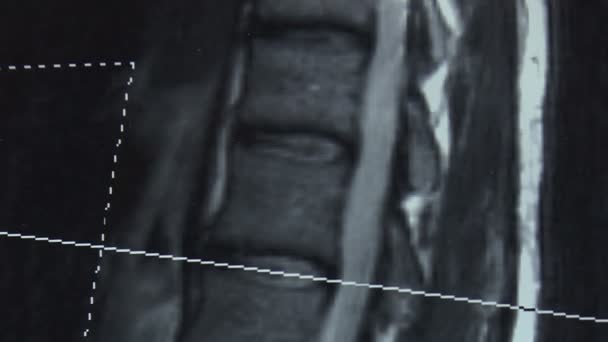 Tomografi, avbildning av ryggraden. Bild. — Stockvideo