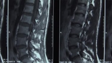 Tomografi, omurga görüntüleme. Resim. 4k.