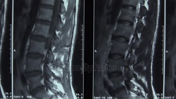 Tomografia, Imagem da coluna vertebral. Imagem. 4K . — Vídeo de Stock