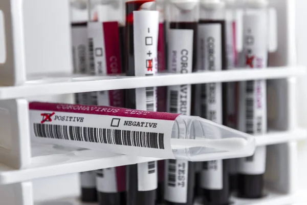 Test Koronawirusowy Spatula Badanie Probówek Szkła Krwi Tle Białym Stelażu — Zdjęcie stockowe