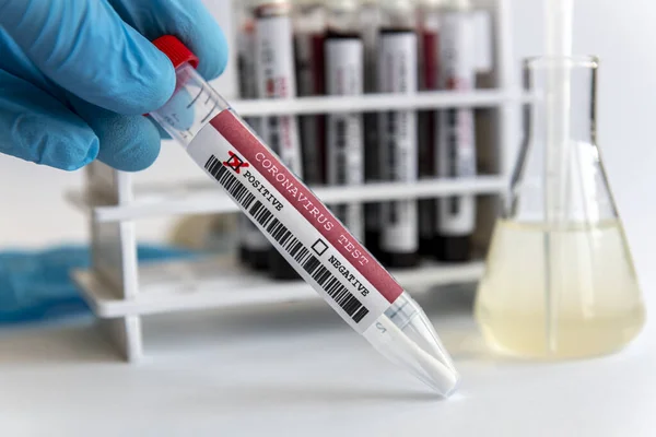 Mano Con Spatola Test Coronavirus Test Tubi Vetro Nel Sangue — Foto Stock