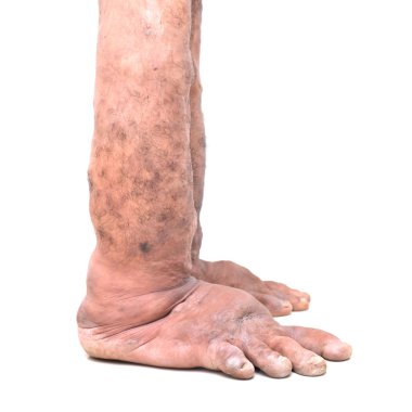 Doğum, filaryaz gibi bozukluklar ayak. kemik hastalıkları