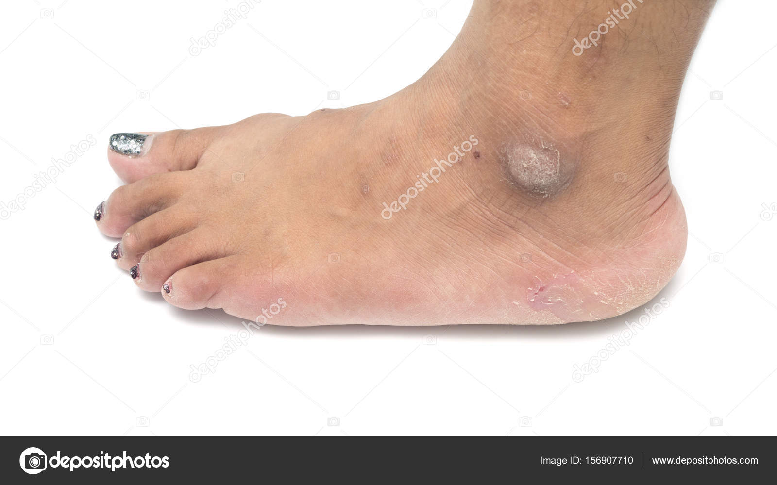 dry skin on ankle