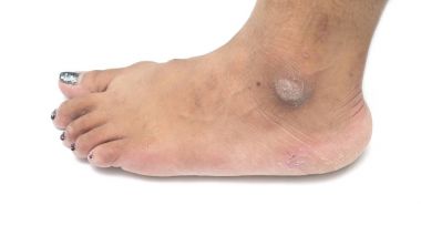 Kuru Cilt topuk üzerinde olan bir kişinin fotoğraf kapatmak