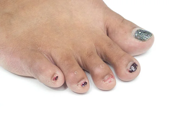 Schimmels op teennagel, nagels zijn niet mooi — Stockfoto