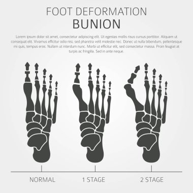 Ayak deformasyon tıbbi desease Infographic olarak. Bunio nedenleri