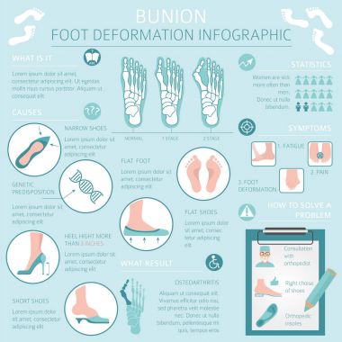 Ayak deformasyon tıbbi desease Infographic olarak. Bunio nedenleri