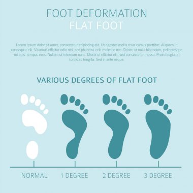 Ayak deformasyon tıbbi desease Infographic olarak. Düz nedenleri 