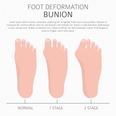 Ayak deformasyon tıbbi desease Infographic olarak. Bunio nedenleri