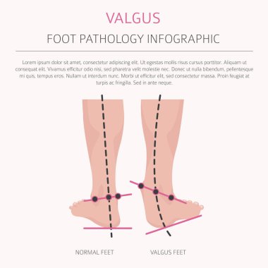 Ayak deformasyon tıbbi desease Infographic olarak. Valgus ve varu