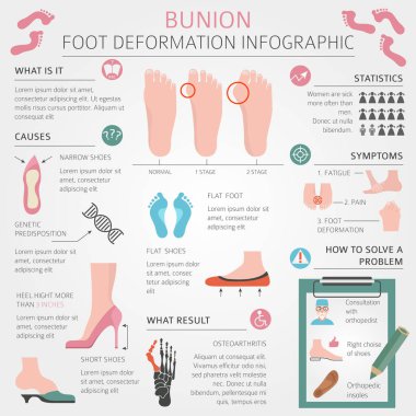 Ayak deformasyon tıbbi desease Infographic olarak. Bunio nedenleri