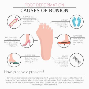 Ayak deformasyon tıbbi desease Infographic olarak. Bunio nedenleri