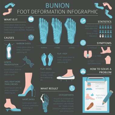 Foot deformation as medical desease infographic. Causes of bunio clipart