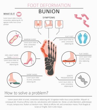 Ayak deformasyon tıbbi desease Infographic olarak. Bunio nedenleri