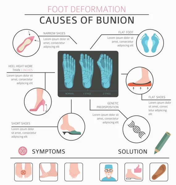 Deformazione del piede come infografica di malattia medica. Cause del bunio — Vettoriale Stock