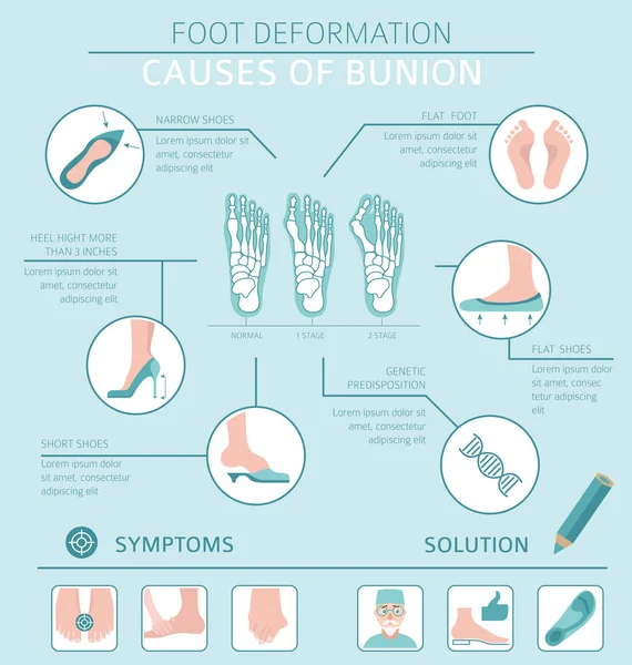 Deformación del pie como infografía médica de la enfermedad. Causas del bunio — Vector de stock