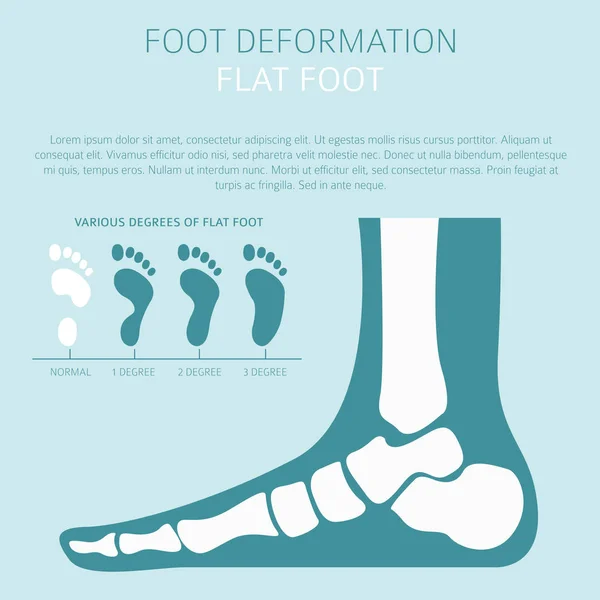 Foot deformation as medical desease infographic. Causes of Flat — Stock Vector