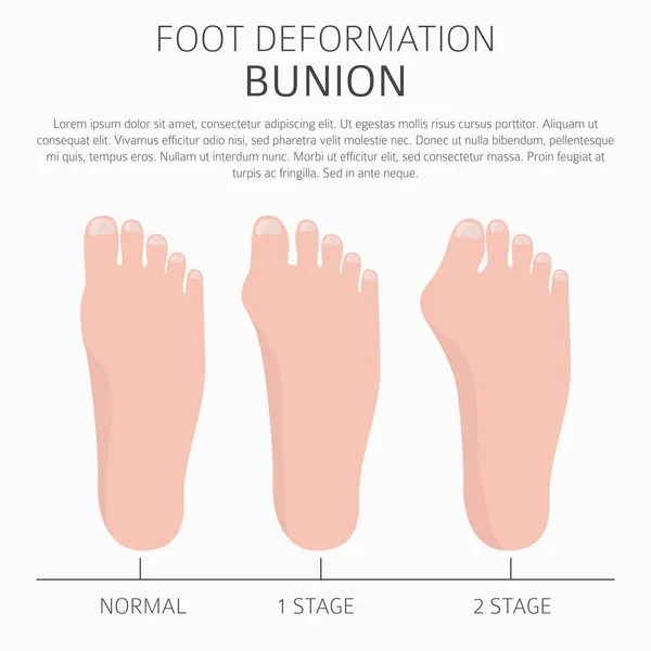 Fußdeformation als medizinische Krankheitsinfografik. Ursachen von Bunio — Stockvektor