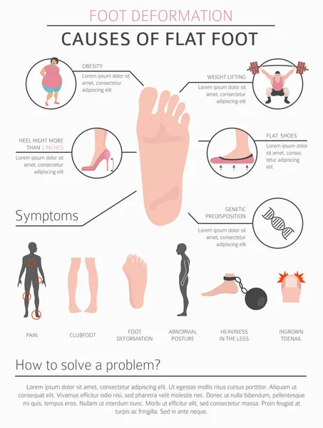 Foot deformation as medical desease infographic. Causes of Flat — Stock Vector