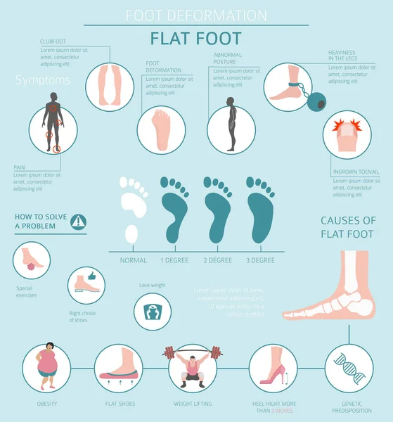 De vervorming van de voet als medische toegegeven infographic. Oorzaken van Flat — Stockvector