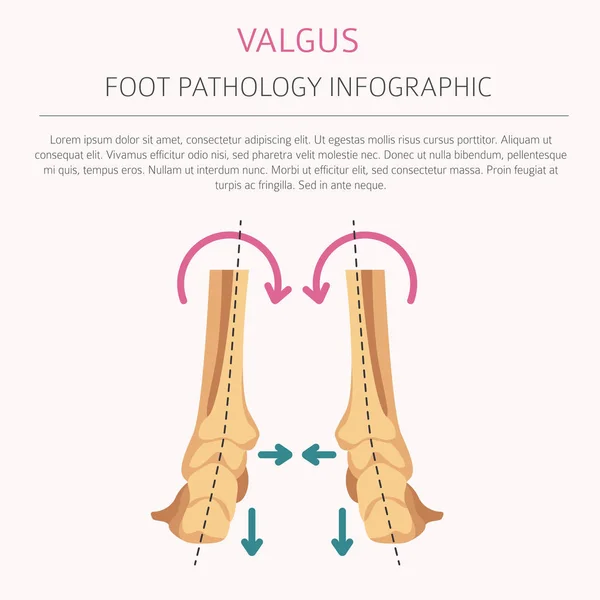 Deformación del pie como infografía médica de la enfermedad. Valgus y varu — Archivo Imágenes Vectoriales