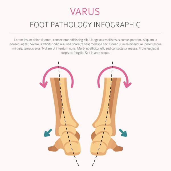 Deformazione del piede come infografica di malattia medica. Valgo e varu — Vettoriale Stock