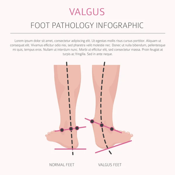 Deformación del pie como infografía médica de la enfermedad. Valgus y varu — Vector de stock