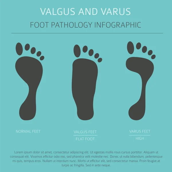 Deformação do pé como infográfico de doença médica. Valgo e varu — Vetor de Stock