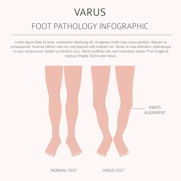 Deformazione del piede come infografica di malattia medica. Valgo e varu — Vettoriale Stock