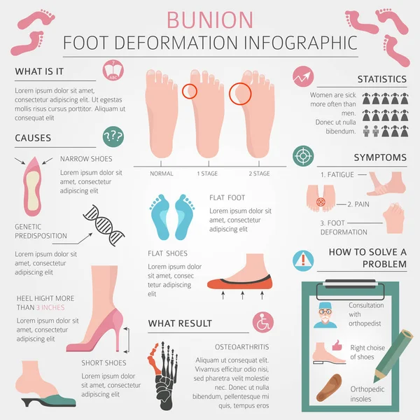 Ayak deformasyon tıbbi desease Infographic olarak. Bunio nedenleri — Stok Vektör