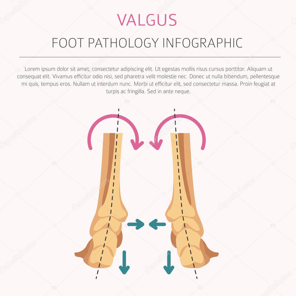 Foot deformation as medical desease infographic. Valgus and varu