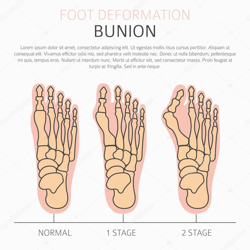 Foot deformation as medical desease infographic. Causes of bunio