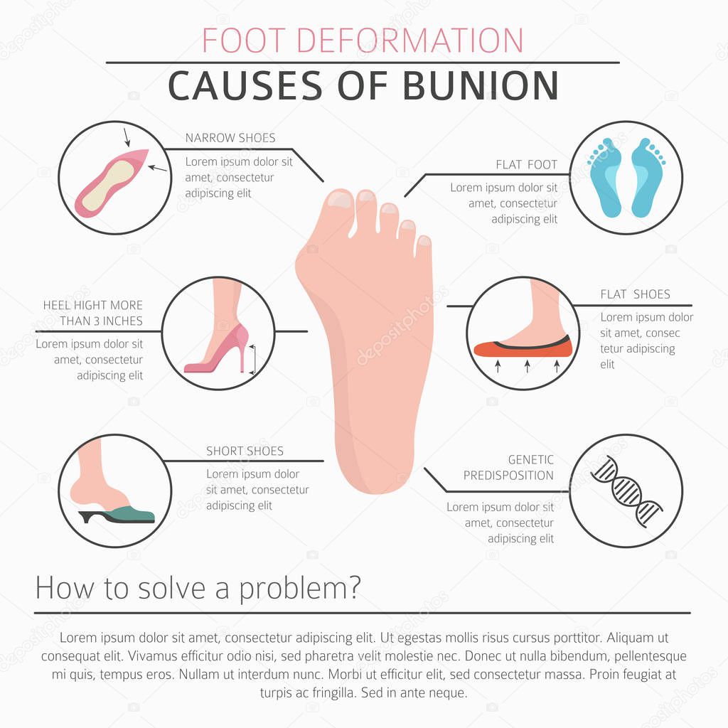 Foot deformation as medical desease infographic. Causes of bunio