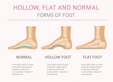 Foot deformation types,  medical desease infographic. Hollow, fl clipart