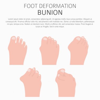 Ayak deformasyon tıbbi desease Infographic olarak. Bunio nedenleri