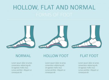 Foot deformation types,  medical desease infographic. Hollow, fl clipart