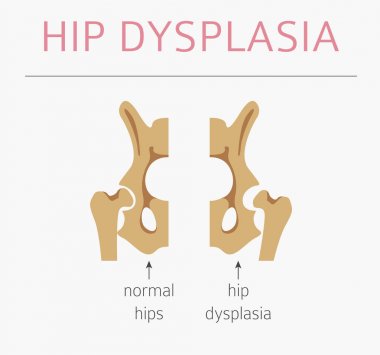 Foot deformation types,  medical desease infographic. Hip dyspla clipart