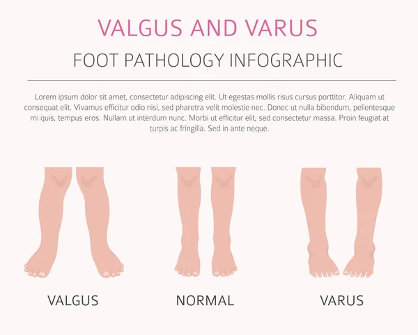 Deformação do pé como infográfico de doença médica. Valgo e varu — Vetor de Stock