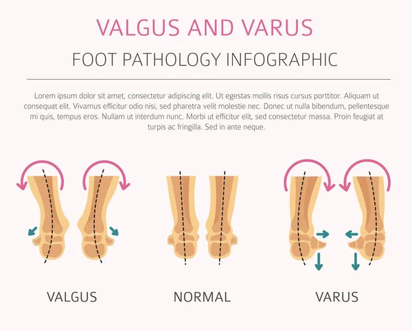 De vervorming van de voet als medische toegegeven infographic. Valgus- en varu — Stockvector