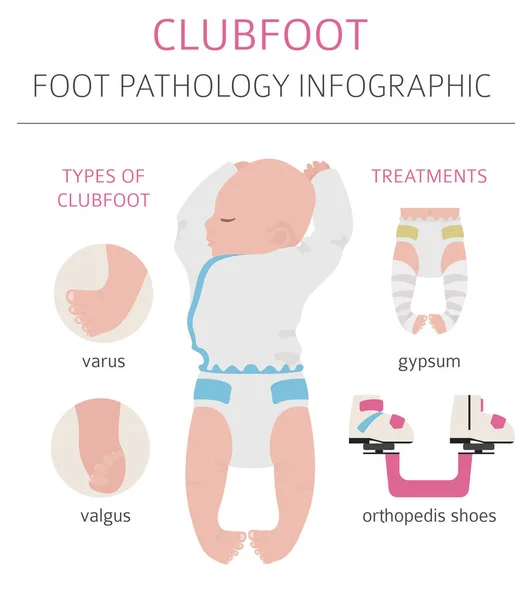 Deformazione del piede, infografica della malattia medica. Difetto del piede del Clubfoot — Vettoriale Stock