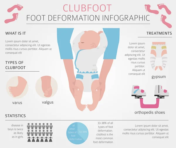 Deformasi kaki, desease infografis medis. Cacat Clubfoot - Stok Vektor