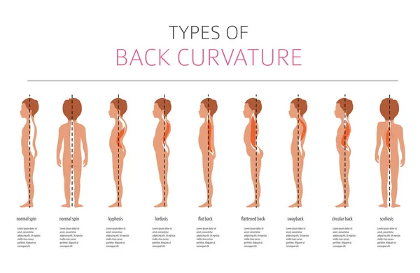 Tipos de curvatura de espalda. Infografía médica de la enfermedad — Archivo Imágenes Vectoriales