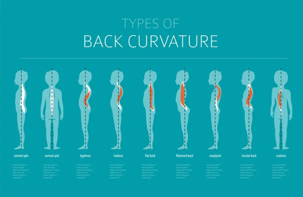 Tipos de curvatura de espalda. Infografía médica de la enfermedad — Archivo Imágenes Vectoriales